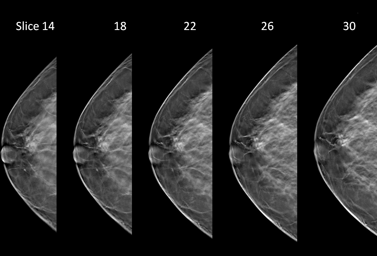 3D Mammography – Harold & Dixie LePere Breast Health Center