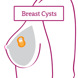 Breast Cysts Harold Dixie LePere Breast Health Center