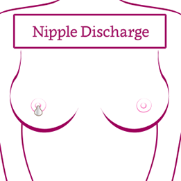 Nipple discharge: Causes and treatments