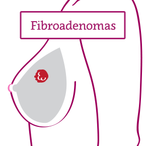 Breast Fibroadenomas: Symptoms, Diagnosis, Treatment