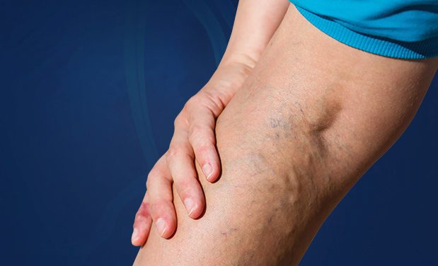 Laser Varicose Vein Removal