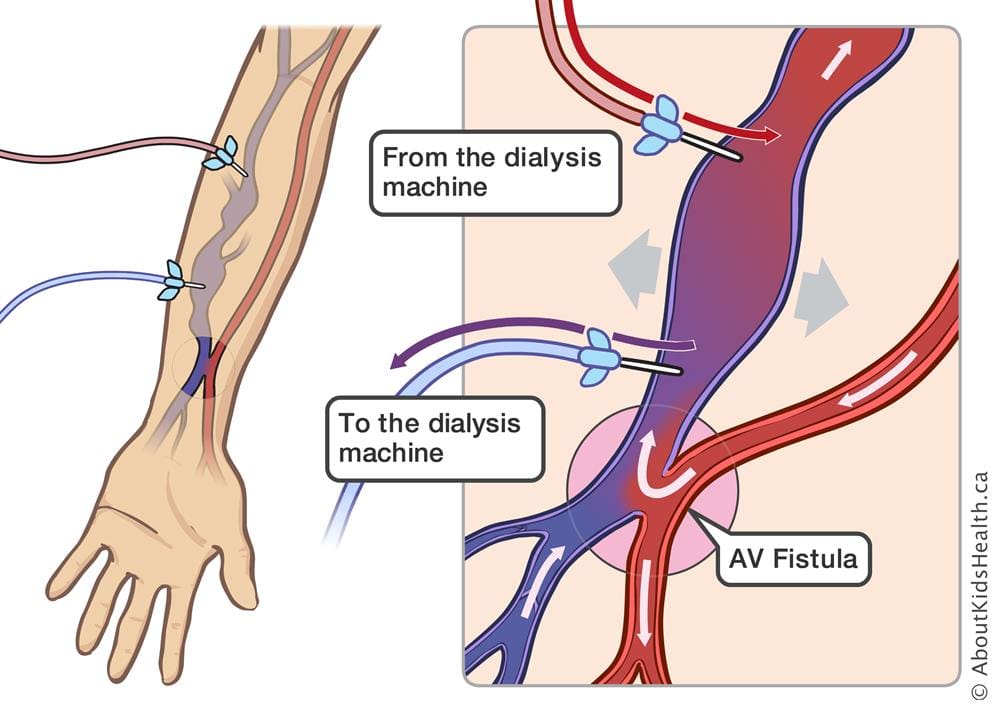 fistula for dialysis placement